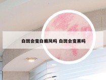 白斑会变白癜风吗 白斑会变黑吗