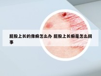 屁股上长的像癣怎么办 屁股上长癣是怎么回事