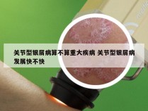 关节型银屑病算不算重大疾病 关节型银屑病发展快不快