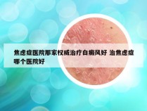 焦虑症医院那家权威治疗白癜风好 治焦虑症哪个医院好