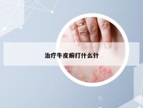 治疗牛皮癣打什么针