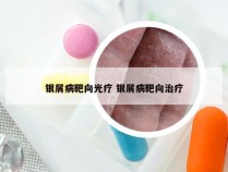 银屑病靶向光疗 银屑病靶向治疗