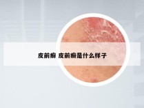 皮前癣 皮前癣是什么样子