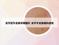 关节型牛皮癣早期图片 关节牛皮肤癣的症状