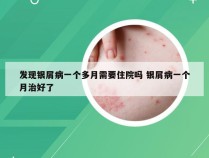 发现银屑病一个多月需要住院吗 银屑病一个月治好了