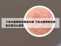 下身大腿两侧皮肤有红癣 下身大腿两侧皮肤有红癣怎么回事