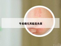 牛皮癣几天能出头屑