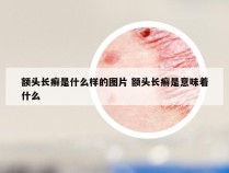 额头长癣是什么样的图片 额头长癣是意味着什么