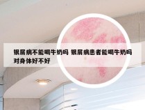 银屑病不能喝牛奶吗 银屑病患者能喝牛奶吗对身体好不好