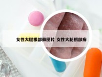 女性大腿根部藓图片 女性大腿根部癣