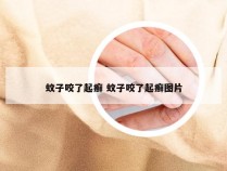 蚊子咬了起癣 蚊子咬了起癣图片