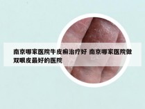 南京哪家医院牛皮癣治疗好 南京哪家医院做双眼皮最好的医院