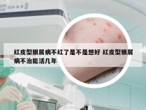 红皮型银屑病不红了是不是想好 红皮型银屑病不治能活几年