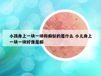 小孩身上一块一块和癣似的是什么 小儿身上一块一块好像是癣