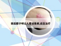 我后膘子咩让人看说象癣,应怠冶疗