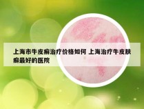 上海市牛皮癣治疗价格如何 上海治疗牛皮肤癣最好的医院