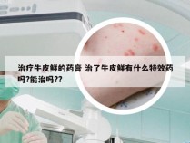 治疗牛皮鲜的药膏 治了牛皮鲜有什么特效药吗?能治吗??