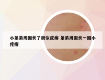 小弟弟周围长了类似皮癣 弟弟周围长一圈小疙瘩