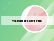 牛皮癣雄黄 雄黄治疗牛皮廨吗