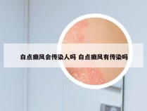 白点癫风会传染人吗 白点癫风有传染吗