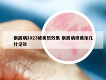 银屑病2023修美乐效果 银屑病修美乐几针见效