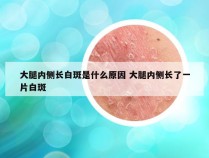 大腿内侧长白斑是什么原因 大腿内侧长了一片白斑