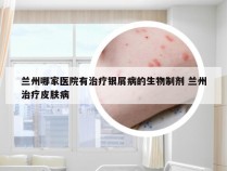 兰州哪家医院有治疗银屑病的生物制剂 兰州治疗皮肤病