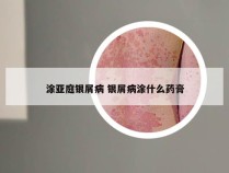 涂亚庭银屑病 银屑病涂什么药膏