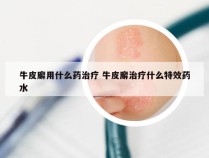 牛皮廨用什么药治疗 牛皮廨治疗什么特效药水