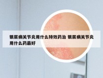 银屑病关节炎用什么特效药治 银屑病关节炎用什么药最好