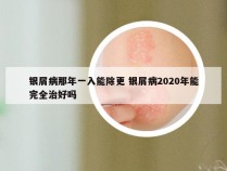 银屑病那年一入能除更 银屑病2020年能完全治好吗