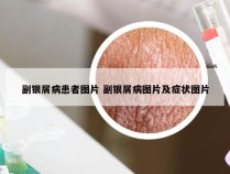 副银屑病患者图片 副银屑病图片及症状图片