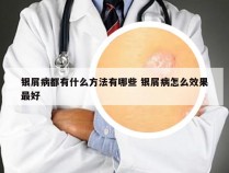 银屑病都有什么方法有哪些 银屑病怎么效果最好