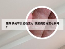 银屑病关节炎能吃三七 银屑病能吃三七粉吗?