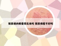 银屑病肉眼看得出来吗 银屑病看不好吗