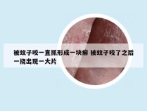 被蚊子咬一直抓形成一块癣 被蚊子咬了之后一挠出现一大片