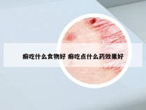 癣吃什么食物好 癣吃点什么药效果好