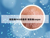 银屑病PASI改善率 银屑病caspar