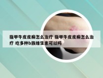 指甲牛皮皮癣怎么治疗 指甲牛皮皮癣怎么治疗 吃多种b族维生素可以吗