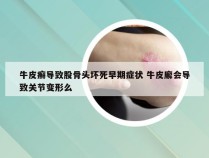 牛皮癣导致股骨头坏死早期症状 牛皮廨会导致关节变形么