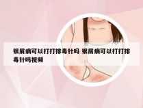 银屑病可以打打排毒针吗 银屑病可以打打排毒针吗视频