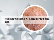 小孩起癣了应该怎么办 小孩起癣了应该怎么办呢