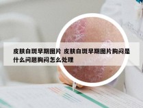 皮肤白斑早期图片 皮肤白斑早期图片胸闷是什么问题胸闷怎么处理