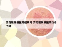 济南银屑病医院招聘网 济南银屑病医院改名了吗