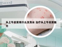 头上牛皮屑用什么洗发水 治疗头上牛皮屑偏方