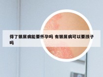 得了银屑病能要怀孕吗 有银屑病可以要孩子吗