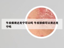 牛皮癣用达克宁可以吗 牛皮肤癣可以用达克宁吗