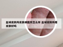 盐城皮防所皮肤病医院怎么样 盐城皮防所看皮肤好吗