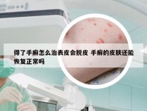 得了手癣怎么治表皮会脱皮 手癣的皮肤还能恢复正常吗