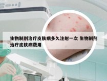 生物制剂治疗皮肤病多久注射一次 生物制剂治疗皮肤病费用